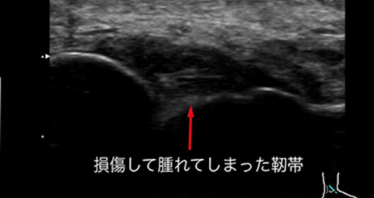 足首の捻挫（靱帯損傷） アフター