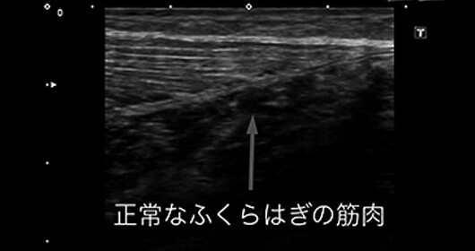 肉離れ（受傷から数年経過） ビフォー