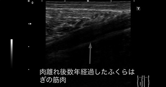 肉離れ（受傷から数年経過） アフター